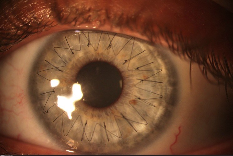Broken Iris