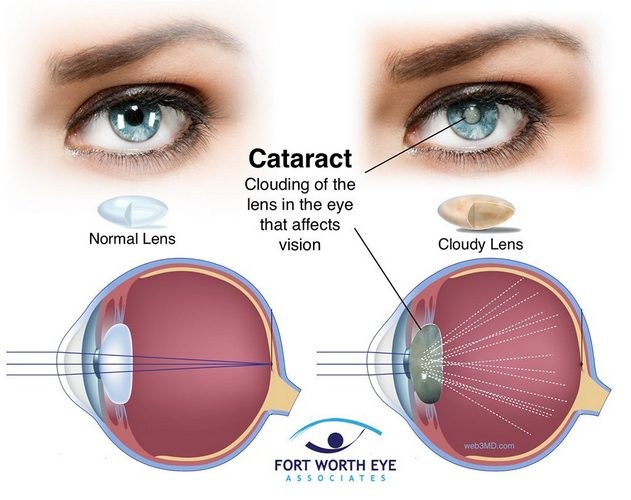 Cataract